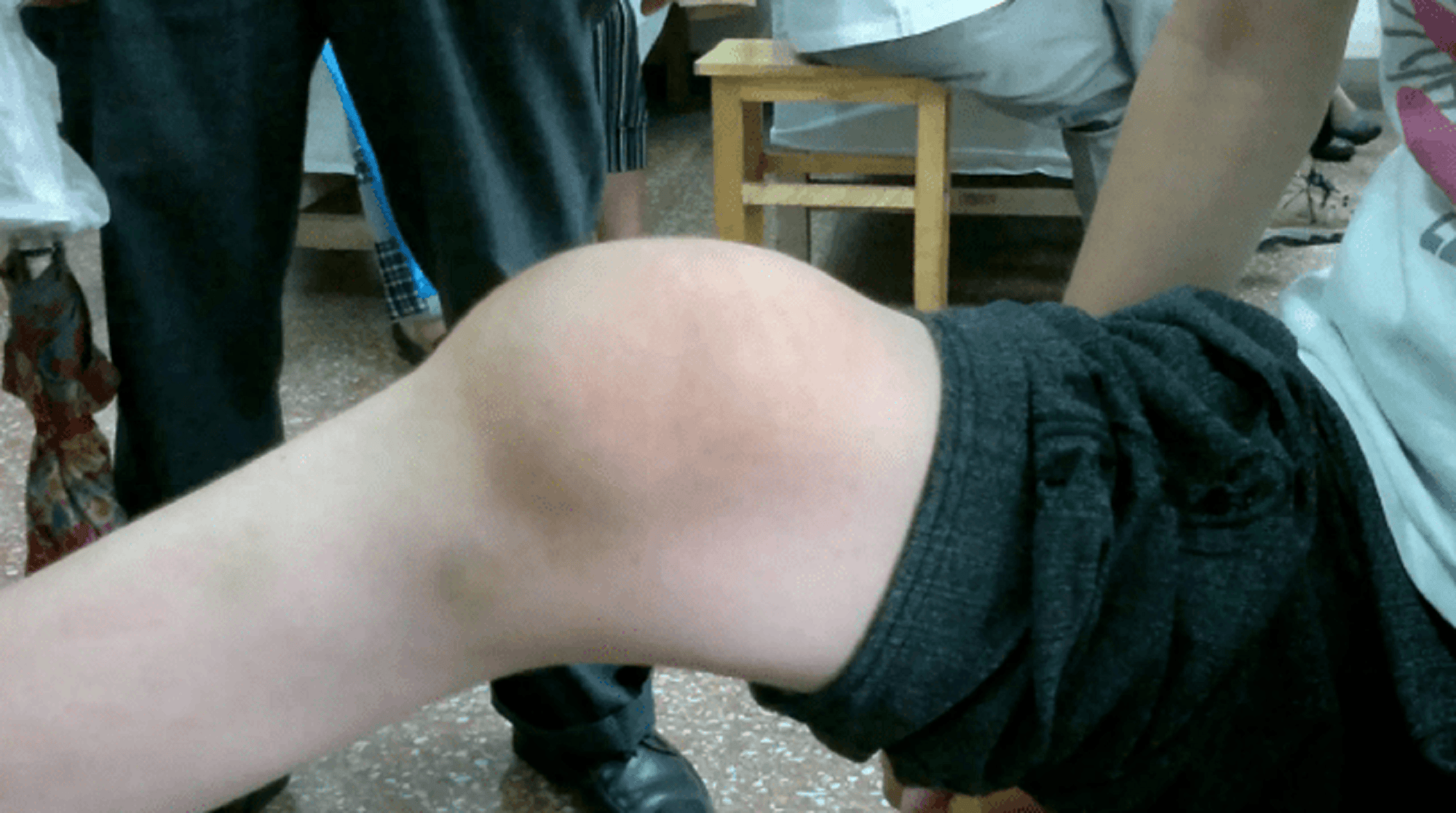 滑膜炎千万别拖!膝盖红肿疼痛试试这3招,适用于98%的患者!