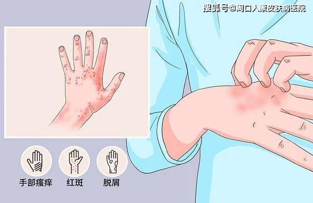 手部_治疗_刺激性