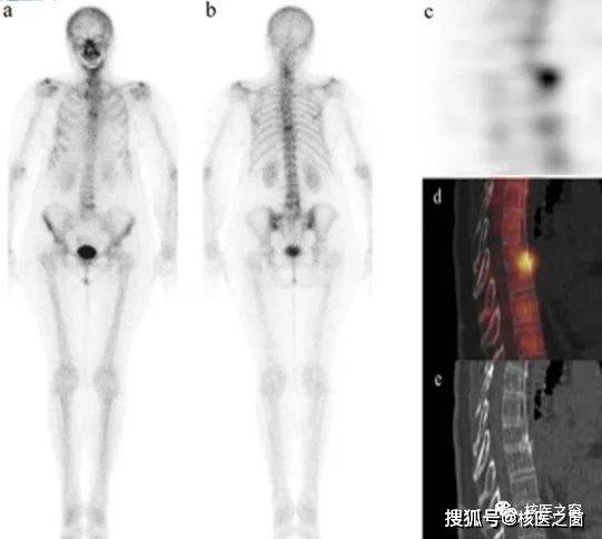 为什么医生让我做spect/ct骨显像?