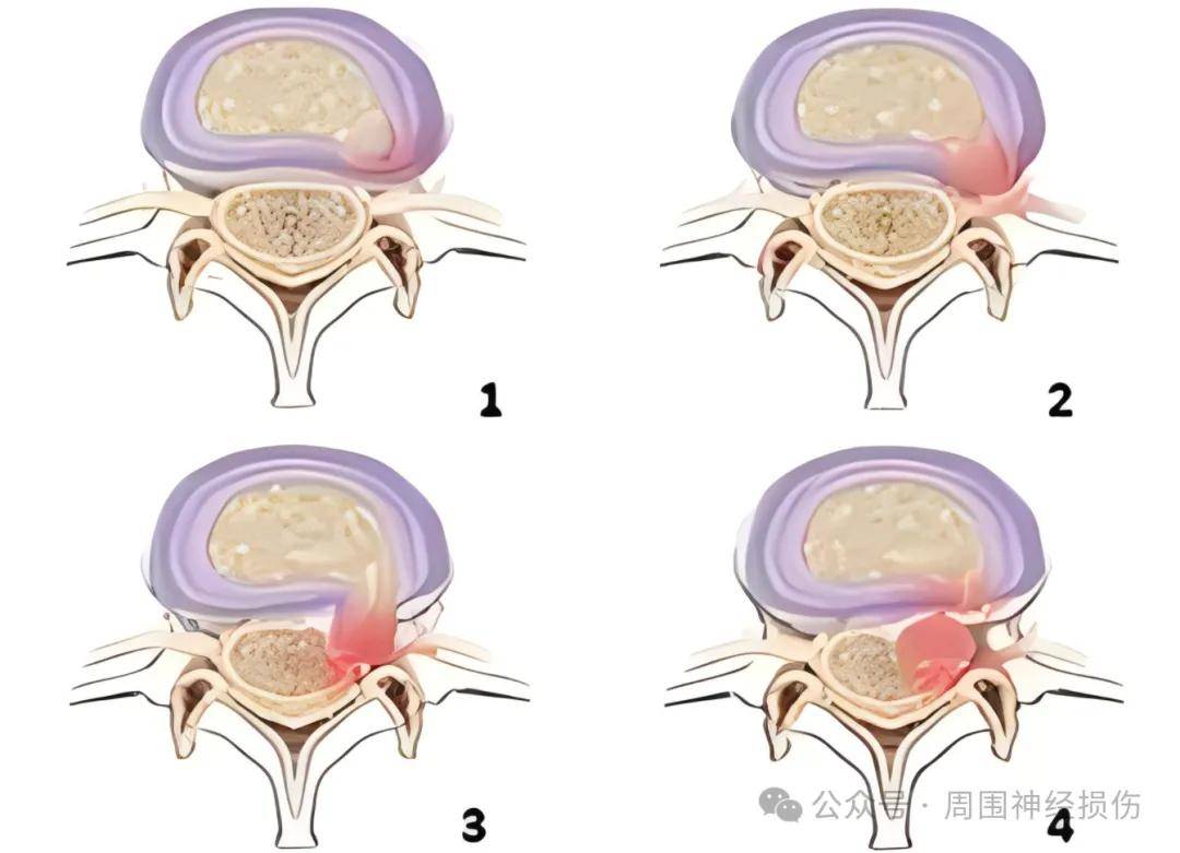 腰椎间盘突出压迫神经