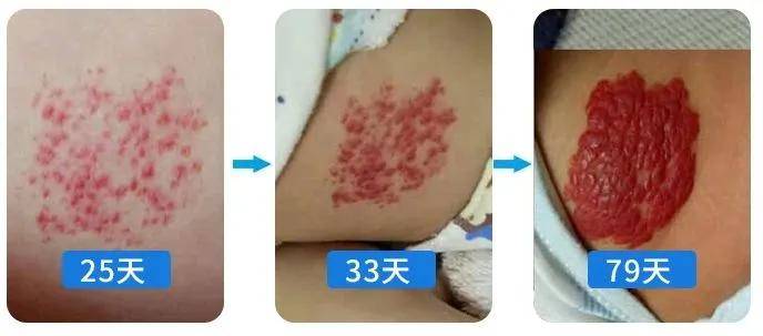 上海曹安医院周天元教您揭秘红胎记还是血管瘤看完这篇便能明白了