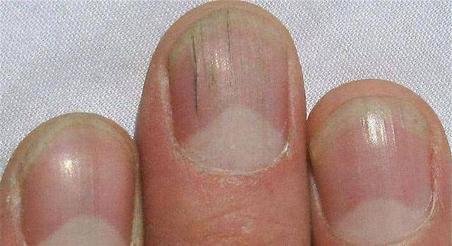 为什么指甲上有竖纹指甲若出现4种异常或是这几种问题的信号