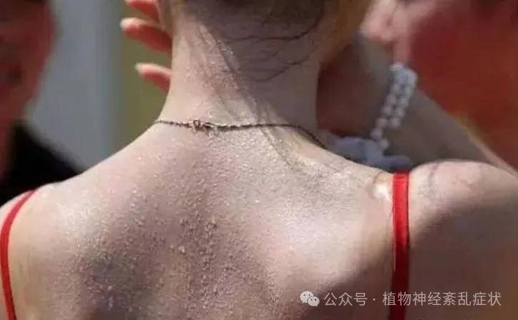 多汗症是一种什么样的体验,多汗症的危害是什么呢?67