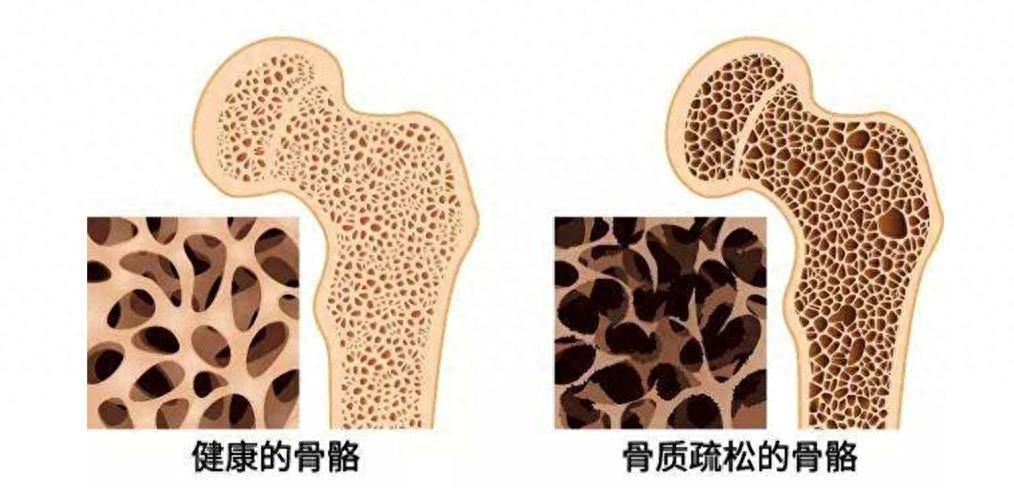 骨质疏松不只是老年病 日常远离这些习惯