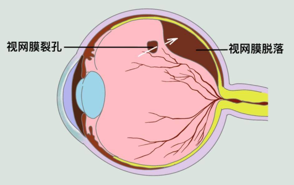 9岁小孩患400度近视,视网膜竟裂了个孔!