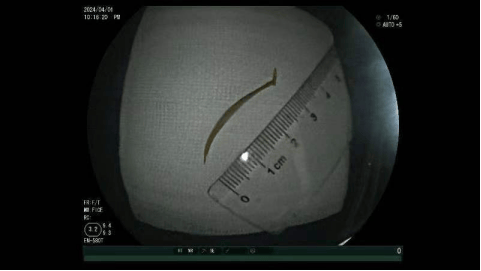 小肠镜下巧取鱼刺免除外科手术之苦