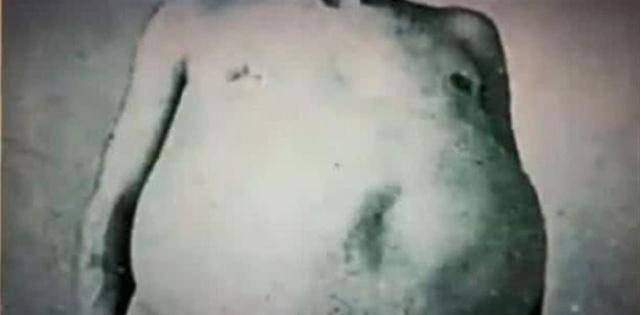 原创世界上被活活憋死的人整整三年没有排泄大肠取出后跟腿一样粗