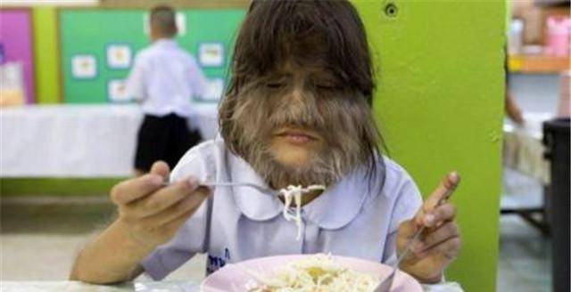 因返祖她全身毛发旺盛,无人愿意亲近,体毛褪下后,网友:好惊艳