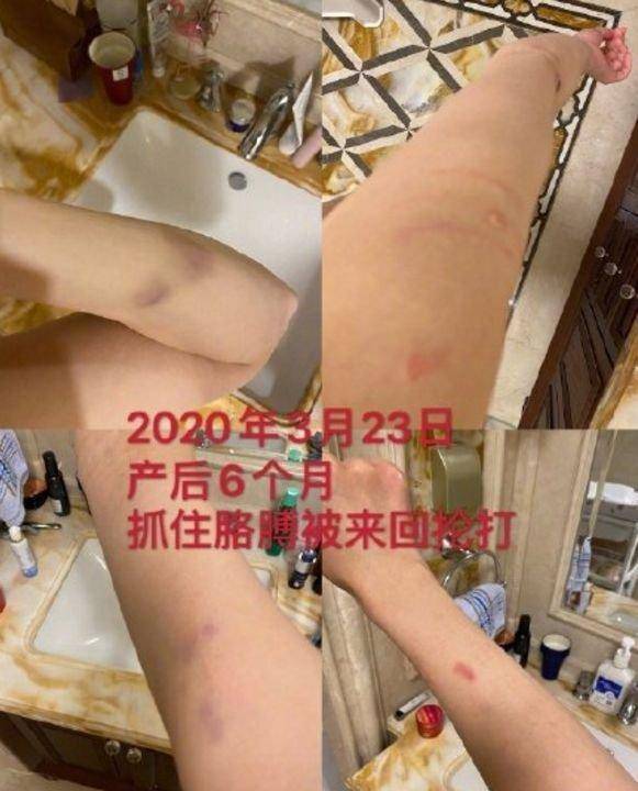 不仅出轨还家暴张培萌妻子晒受伤图怀孕坐月子哺乳期都被打过
