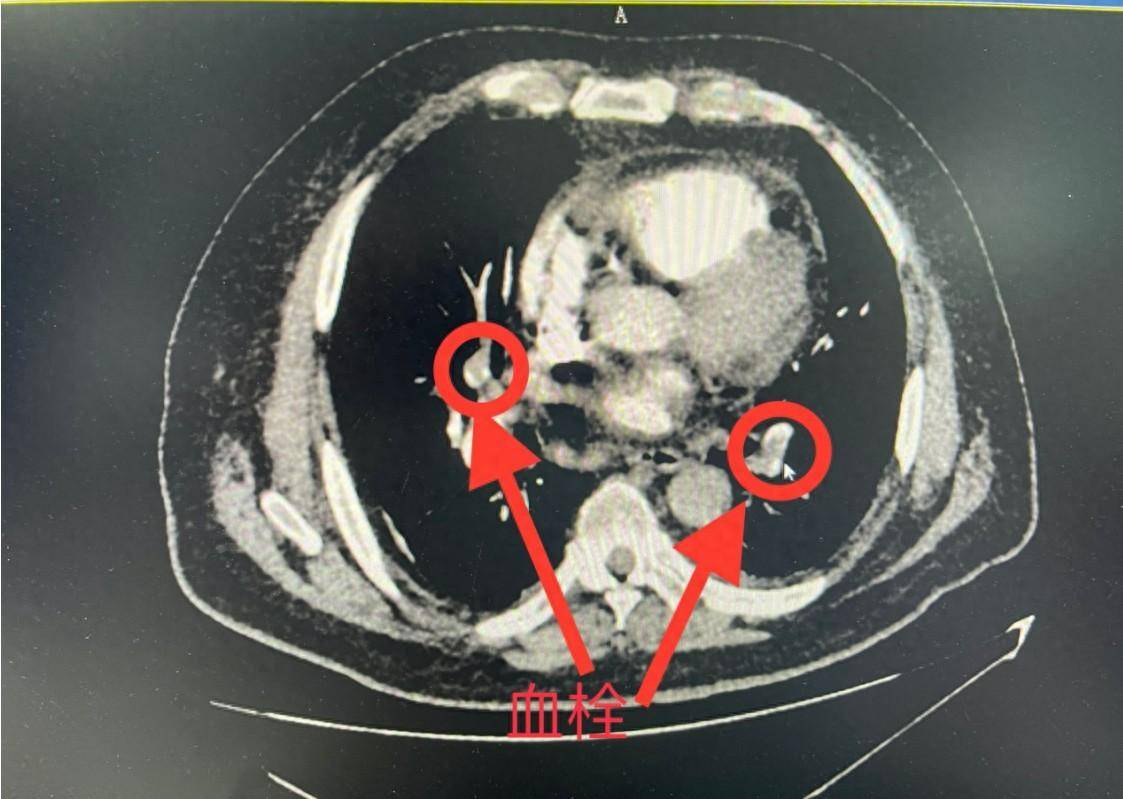 经过一系列的检查后,元凶被揪了出来,刘爷爷的肺动脉造影检查结果