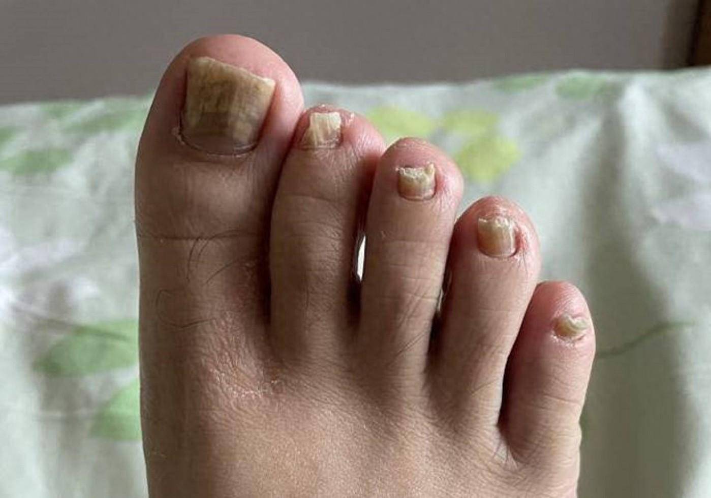 5年灰指甲终于根治过来人教你去灰经验不花冤枉钱