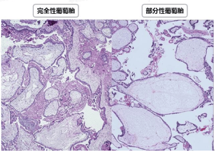 葡萄胎b超图片图片