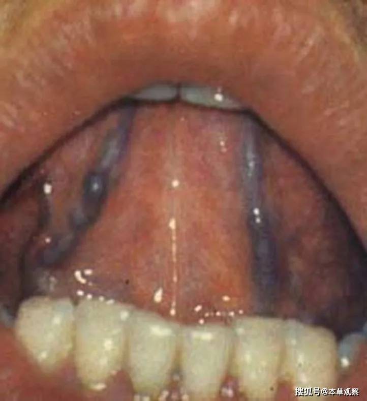 血瘀表现舌下络脉,作为我们能观察到的最表浅的血管,能直观的反映出