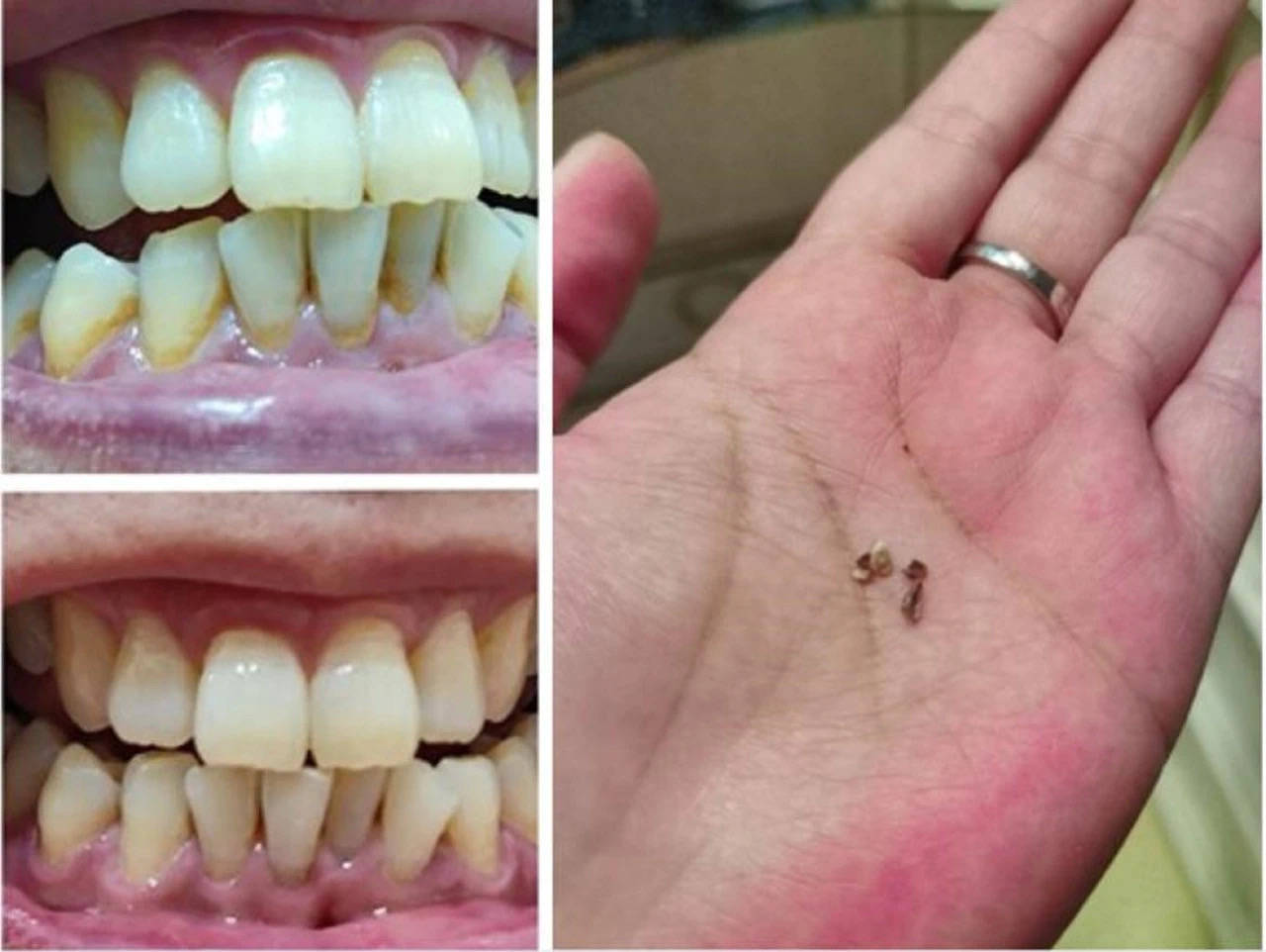 黄厚牙结石堆成山?学会这三招,在家18天就能轻松除石!