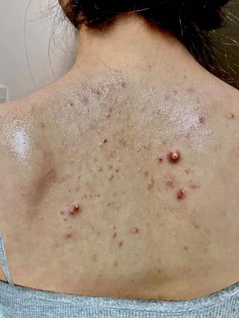 夏天不想爆痘出油,注意这几点!0成本轻松搞定螨虫!
