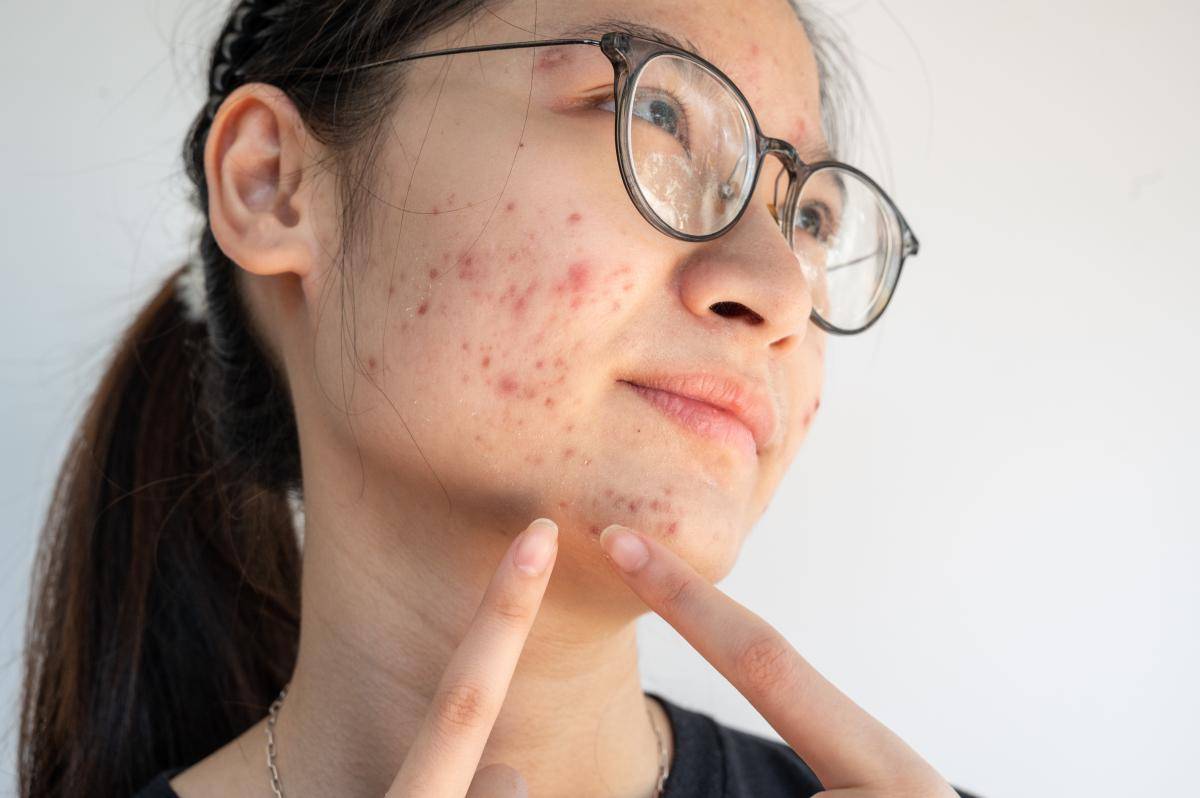 男女痘痘肌肤存在差异,需要根据不同的特点采取相应的护理重点|战痘