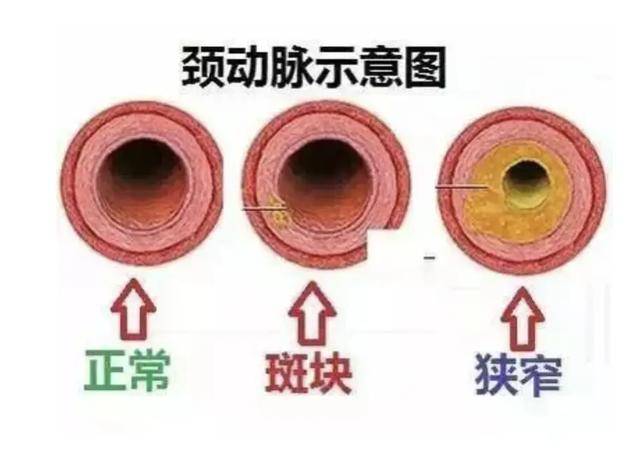 颈部血管凸起图片