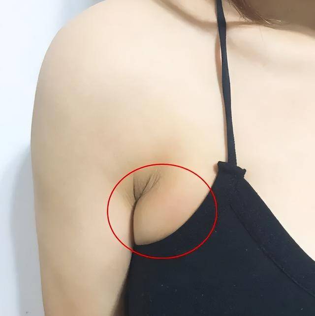 初期乳腺癌图片大全图片