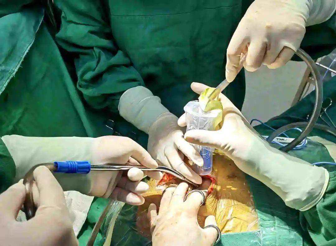 临沂市肿瘤医院妇瘤团队为93岁患者成功切除巨大卵巢肿瘤