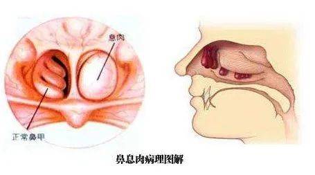 正常鼻子与鼻炎图片图片