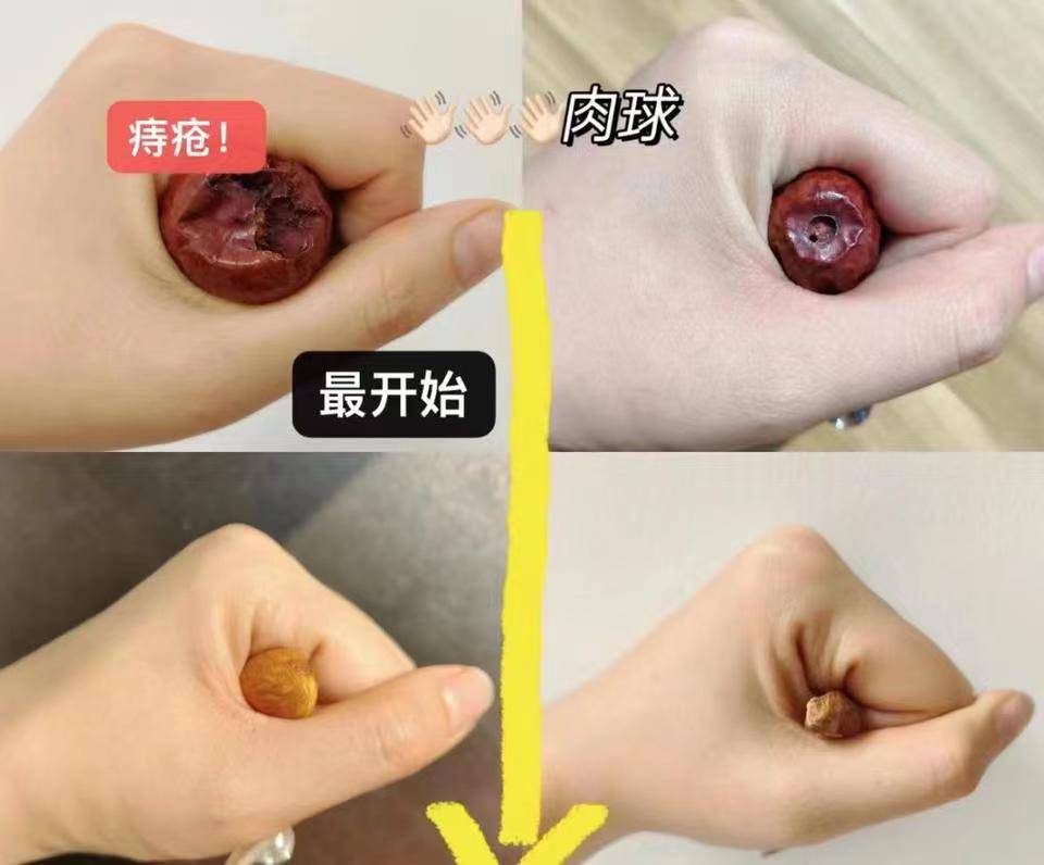 学会这些技巧,就能在家里轻松治疗痔疮!