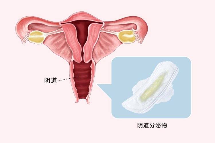 宫颈癌分泌物图片早期图片