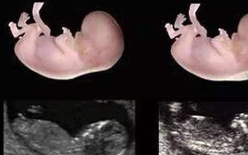 Nt胎儿头颅形状看男女图片