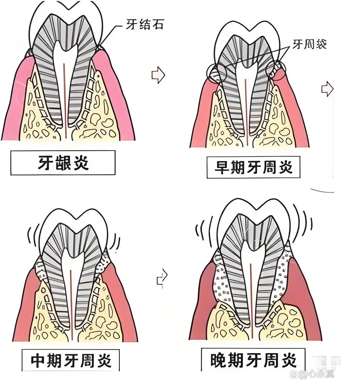 牙周病的治疗方法图片