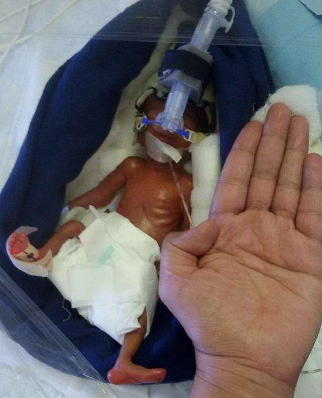 当初,那位打破吉尼斯世界纪录的"拇指宝宝",如今现状如何?