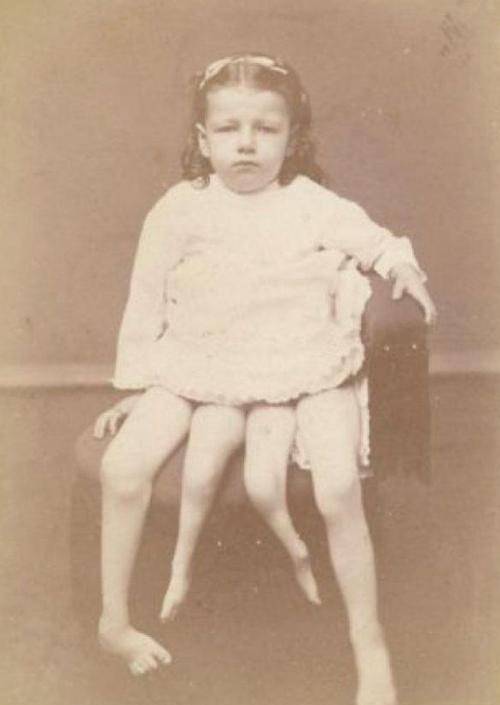 女孩天生拥有四脚,出生时轰动世界,为补贴家里四处巡演,后怎样_科尔宾