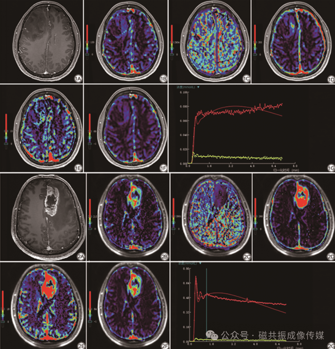 多模态多参数磁共振成像在脑胶质瘤ki-67表达中的研究