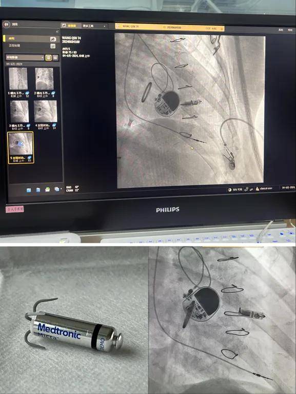 小"胶囊"强动力!我院心血管内科成功实施首例无导线起搏器植入手术