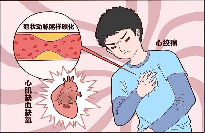 合源单硝酸异山梨酯缓释胶囊健康科普:浅谈对冠心病的认识及防治!