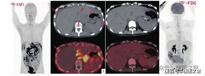18f-fapi pet/ct显像,让癌症诊断更准确!