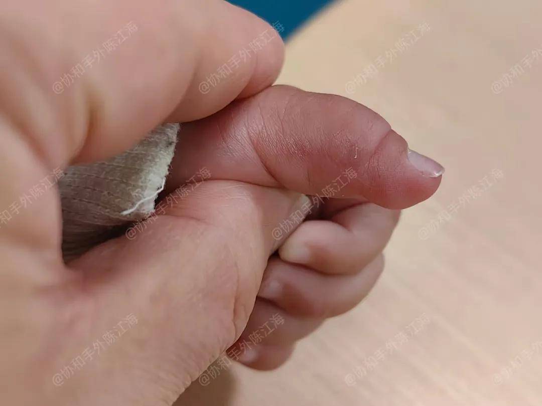 宝宝天生小六指,家族遗传已三代