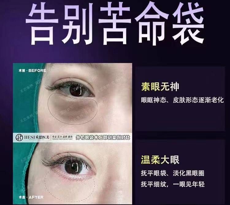 下沙做眼袋费用