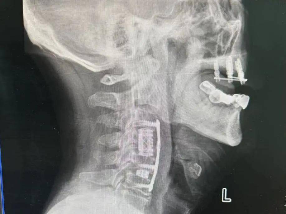 【医大技术】我院骨科成功完成颈前路椎体次全切除 钛网植骨融合内