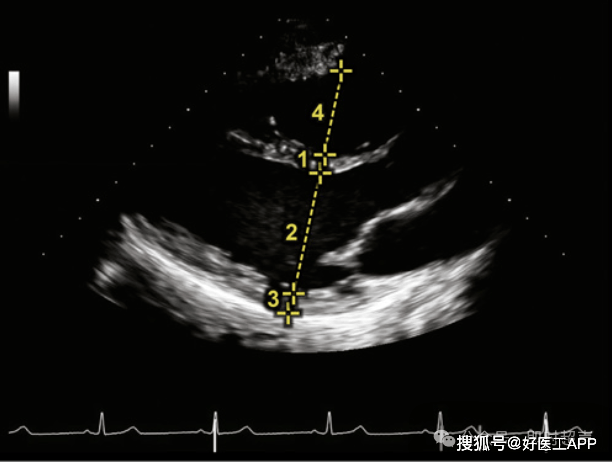 床旁超声心动图的基本测量