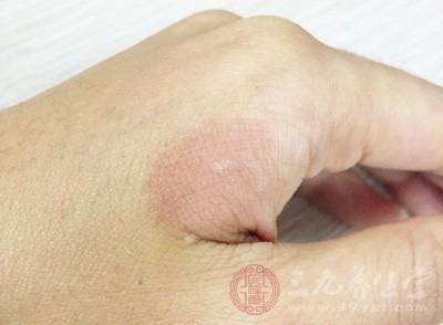 疱疹啥症状常做这件事竟会引起疱疹