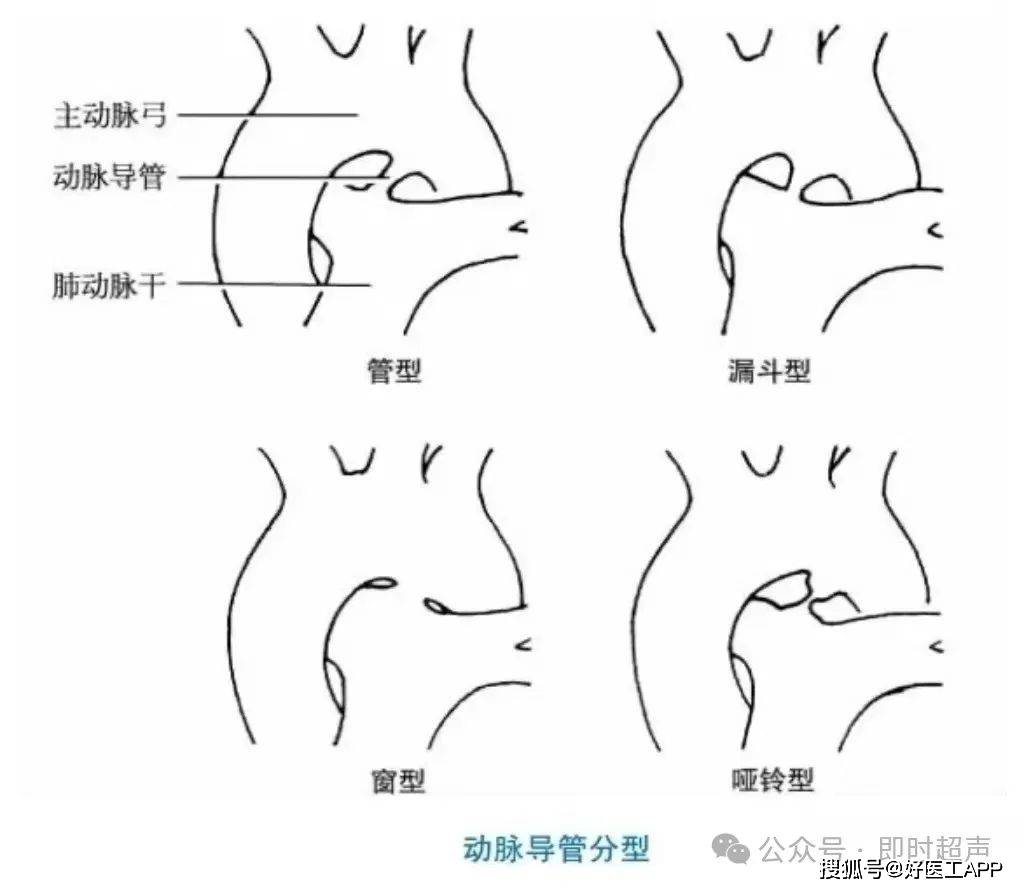 动脉导管未闭超声ppt图片