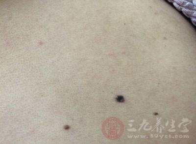 有血痣一定是肝癌吗这种血痣要特别注意