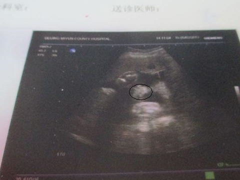 怀孕48天b超图片图片