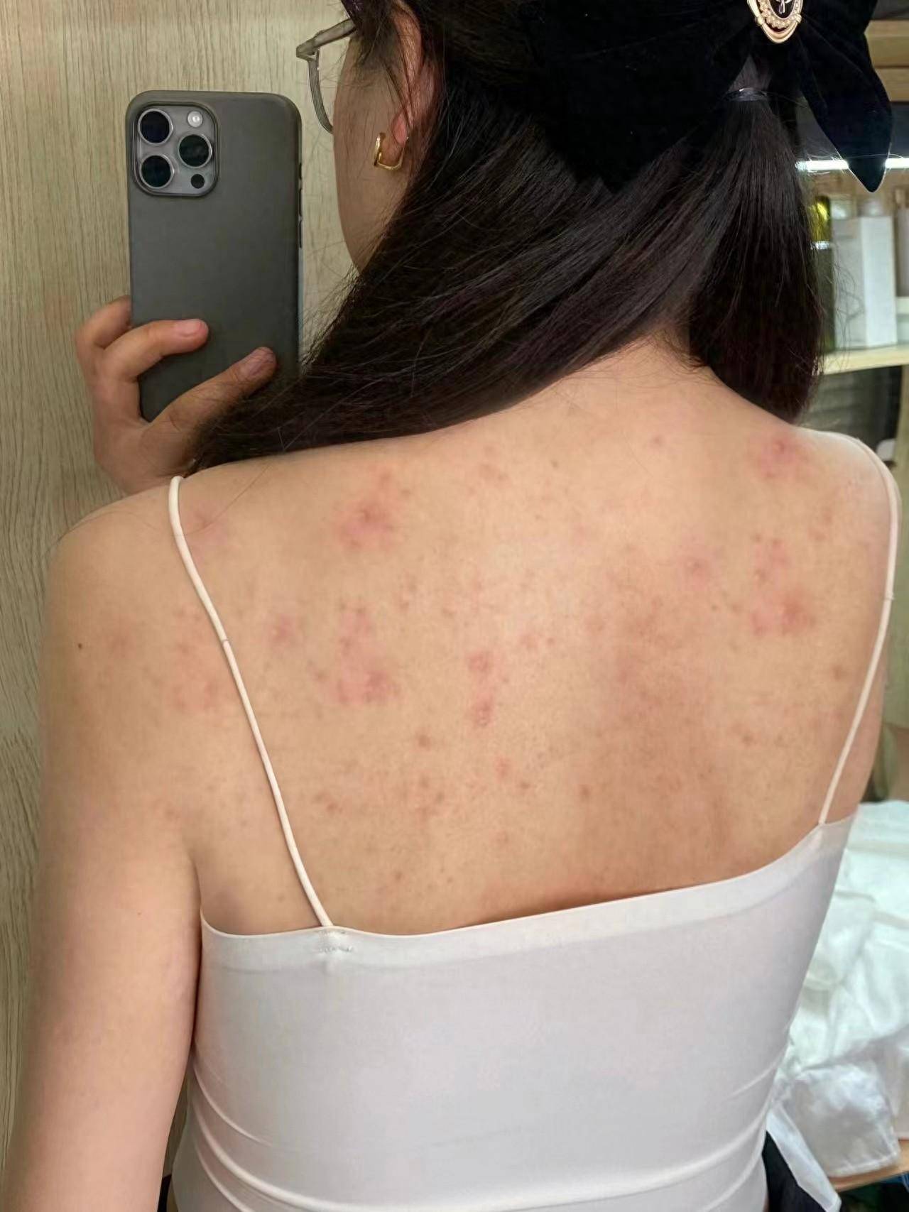 前胸后背频繁长螨虫痘痘?教你两招轻松搞定!