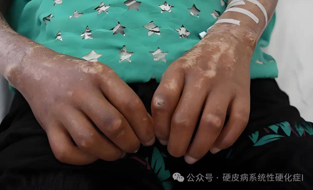 硬皮病不可怕,正确认识是关键