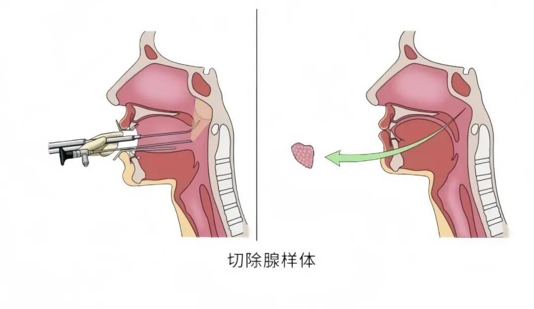 拉低颜值,不长个,影响智力.儿童"腺样体肥大" 暑期治疗正当时