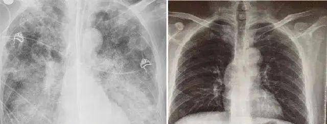 正常情况下,我们的肺含有的气体量比较多,当正常人去做肺部ct的时候