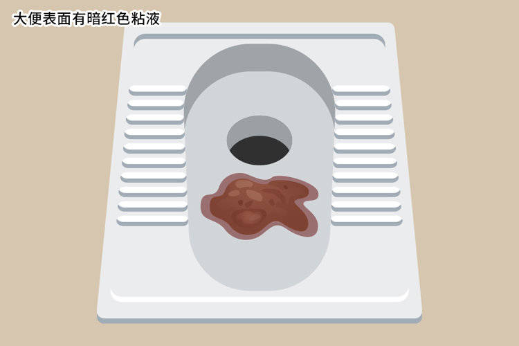 大便"前头干硬,后边软粘"?可能是这3种病害的很多人没意识到