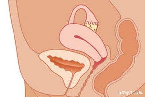 小心宫颈癌最爱"便秘"女性