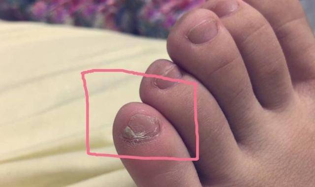 小脚趾甲分成"两瓣"的人,是纯汉族人?你是这样的吗