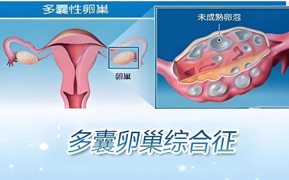 "多囊卵巢综合征"(pcos)是育龄期女性最常见的内分泌疾病,其发病率约